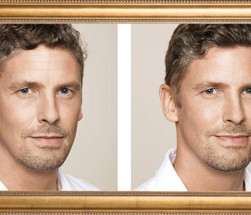 Botox voor mannen: hoe een hype een trend werd!