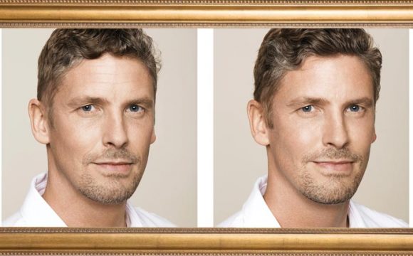 Botox voor mannen: hoe een hype een trend werd!